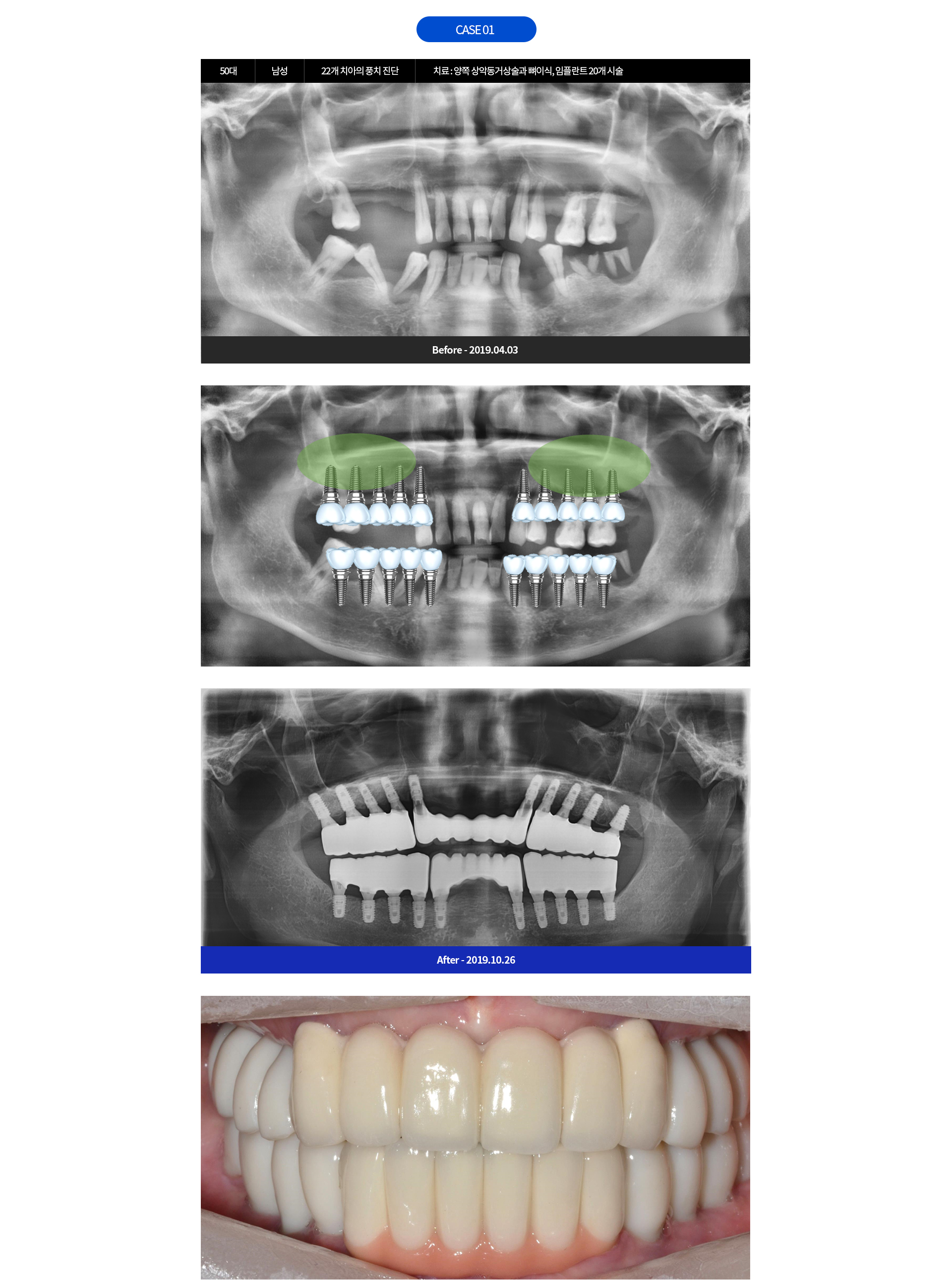 CASE 01 - 50대 남성 22개 치아의 풍치 진단 | 치료 : 양쪽 상악동거상술과 뼈이식, 임플란트 20개 시술