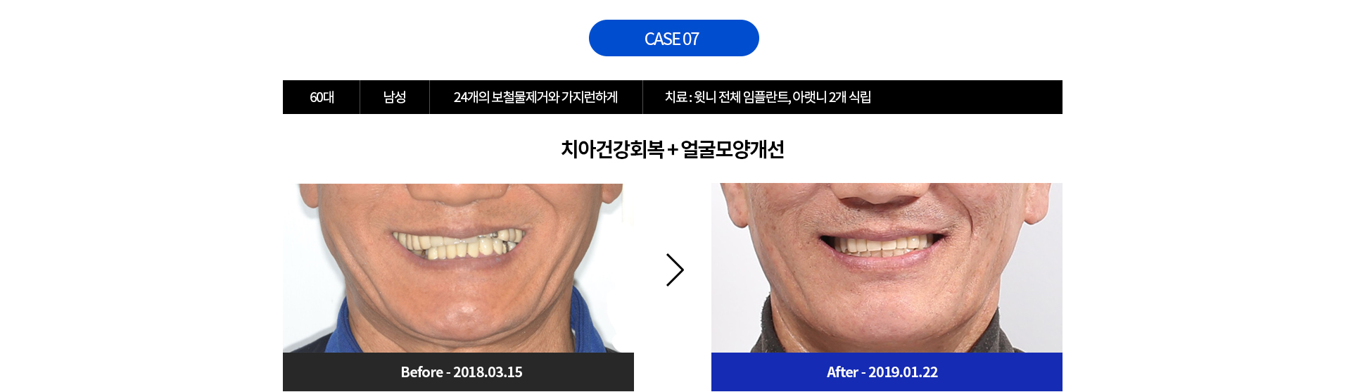 CASE 07 - 60대 남성 24개의 보철물제거와 가지런하게 | 치료 : 윗니 전체 임플란트, 아랫니 2개 식립 | 치아건강회복 + 얼굴모양개선