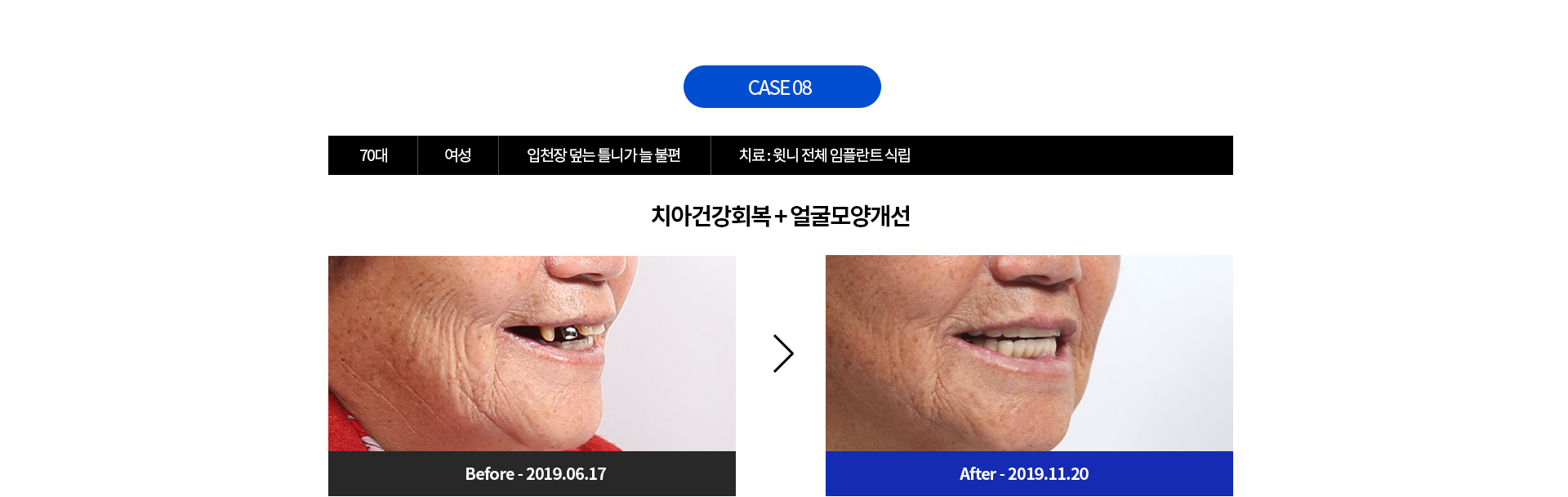 CASE 08 - 70대 여성 입천장 덮는 틀니가 늘 불편 | 치료 : 윗니 전체 임플란트 식립 | 치아건강회복 + 얼굴모양개선