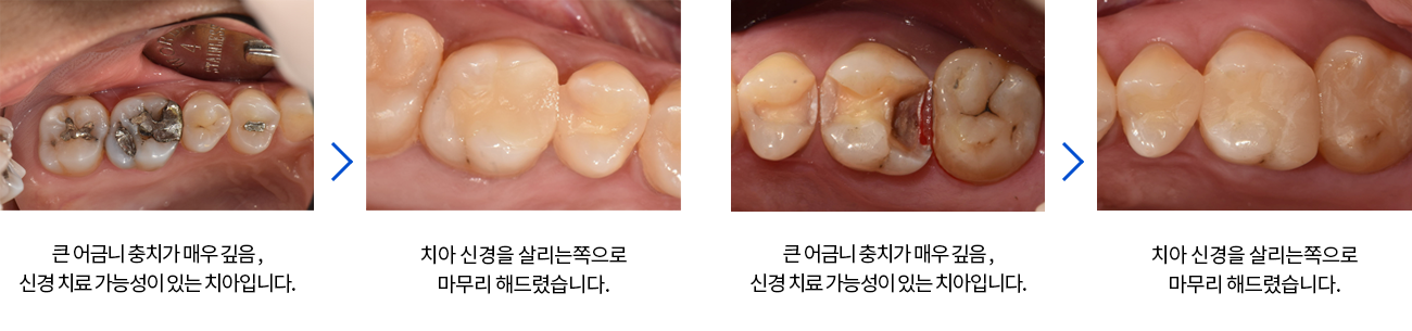 큰 어금니 충치가 매우 깊음 , 신경 치료 가능성이 있는 치아입니다.|치아 신경을 살리는쪽으로 마무리 해드렸습니다.|큰 어금니 충치가 매우 깊음 , 신경 치료 가능성이 있는 치아입니다.|치아 신경을 살리는쪽으로 마무리 해드렸습니다.